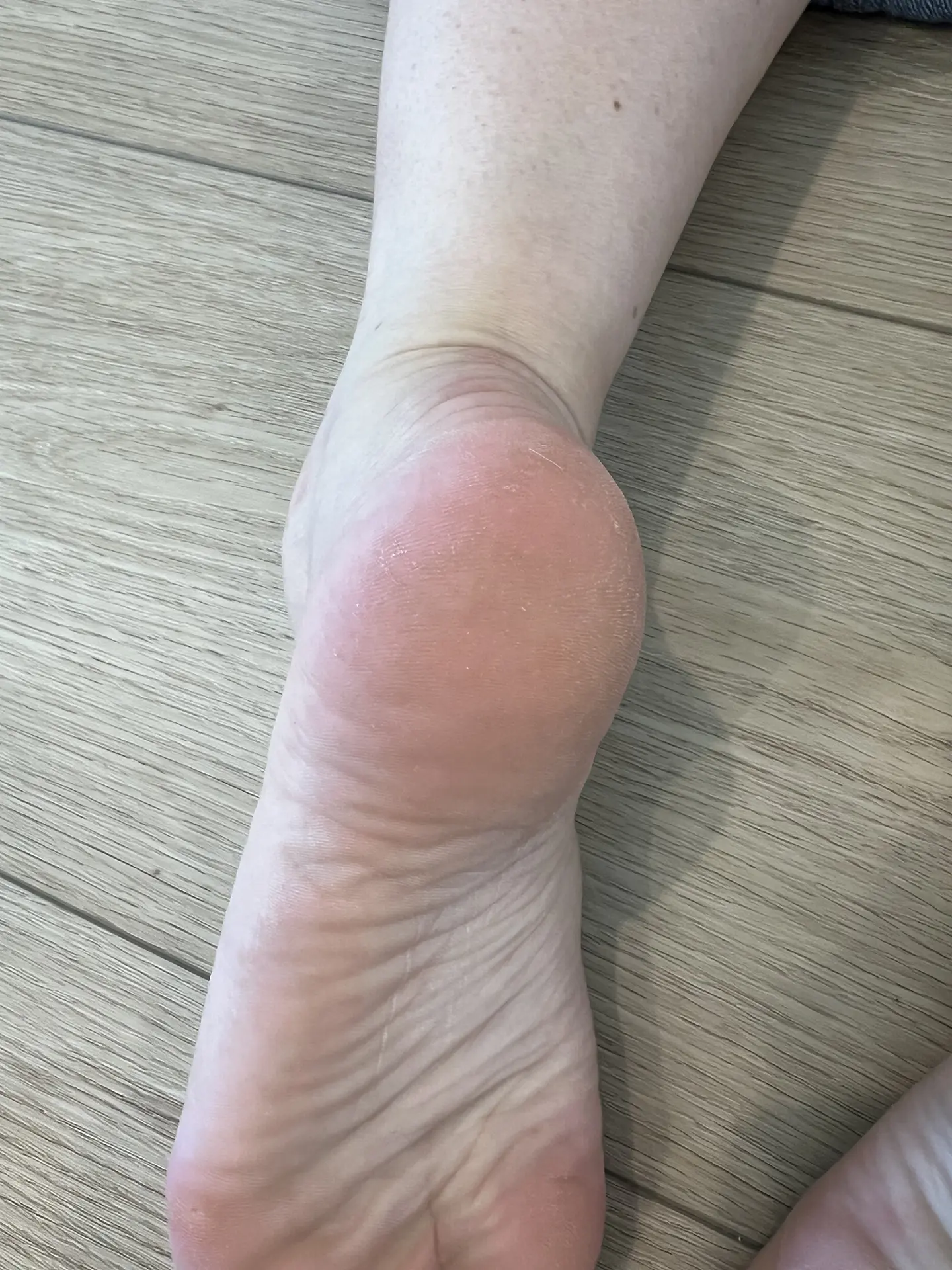 Feet after Maundy application