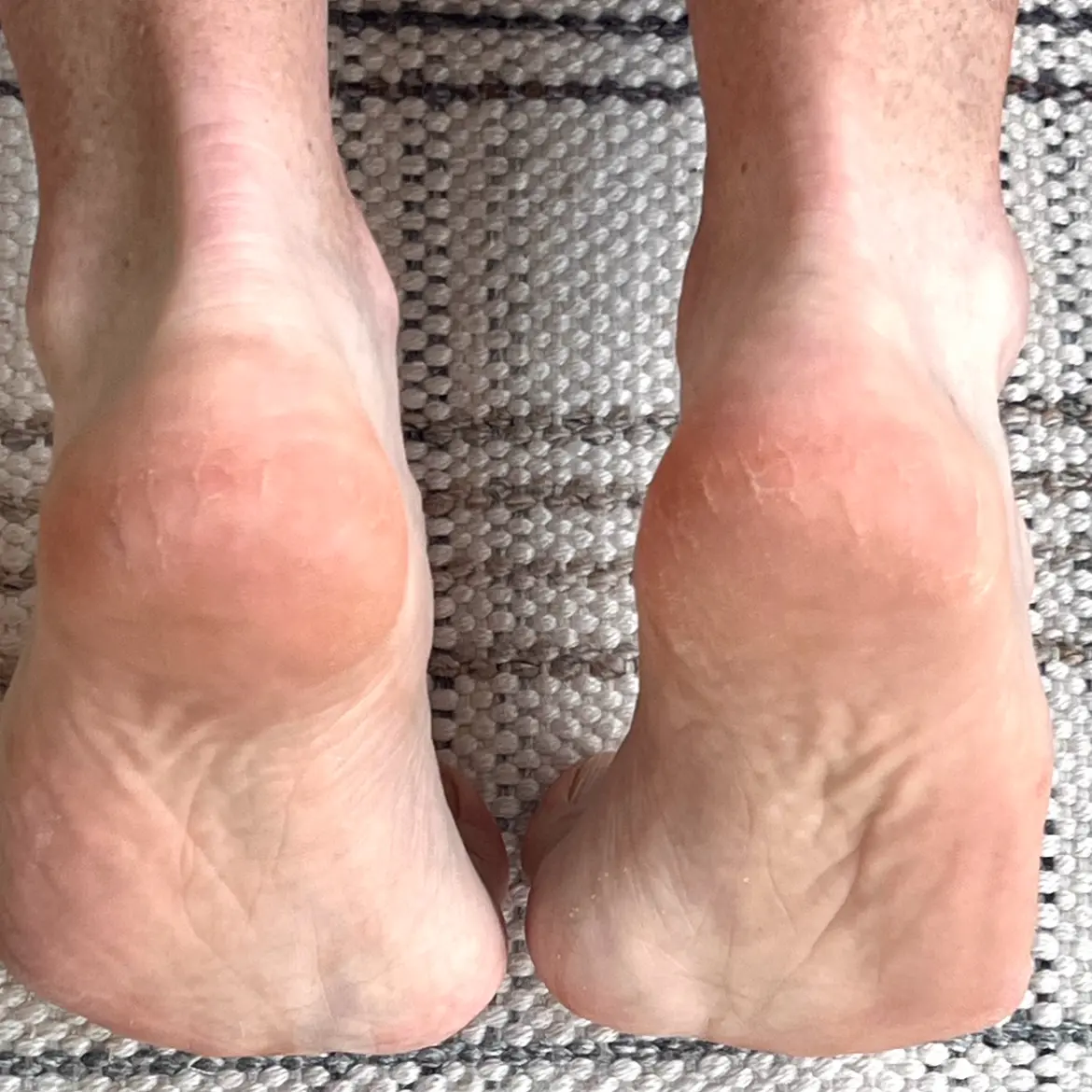 Feet after Maundy application